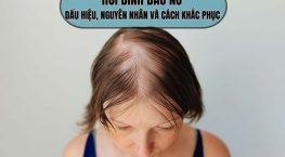 Hói đỉnh đầu nữ: Dấu hiệu, nguyên nhân & giải pháp phục hồi tóc hiệu quả