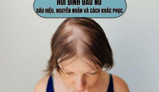 Hói đỉnh đầu nữ: Dấu hiệu, nguyên nhân & giải pháp phục hồi tóc hiệu quả