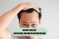 Hói đầu ở nam giới – Nguyên nhân, dấu hiệu và giải pháp hiệu quả