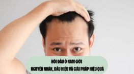Hói đầu ở nam giới – Nguyên nhân, dấu hiệu và giải pháp hiệu quả