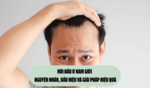 Hói đầu ở nam giới – Nguyên nhân, dấu hiệu và giải pháp hiệu quả