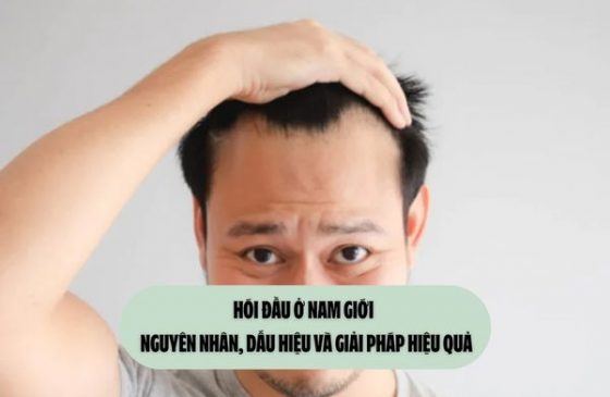 Hói đầu ở nam giới – Nguyên nhân, dấu hiệu và giải pháp hiệu quả