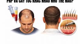 PRP và cấy tóc khác nhau như thế nào? So sánh để chọn đúng