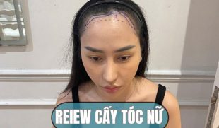 Review cấy tóc nữ: Chia sẻ trải nghiệm thực tế tại Phòng khám Cấy ghép Tóc Y học Quốc tế