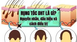 Rụng tóc DHT là gì? Nguyên nhân, dấu hiệu và giải pháp điều trị hiệu quả hiện nay