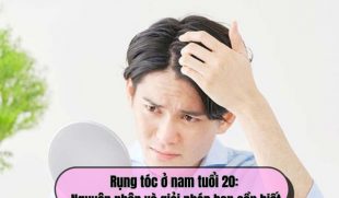 Rụng tóc ở nam tuổi 20: Nguyên nhân và giải pháp bạn cần biết