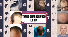Thang điểm Norwood là gì? Cách đánh giá mức độ hói đầu và hướng điều trị hiệu quả