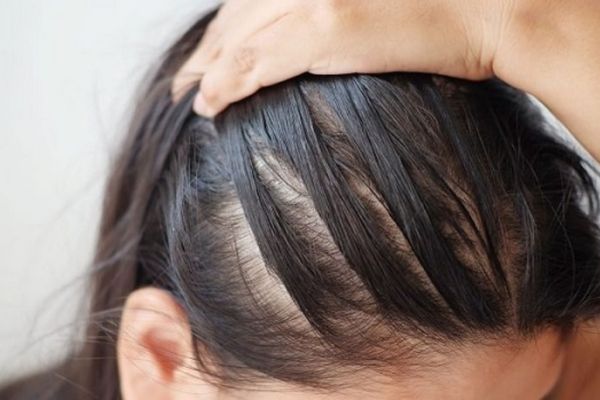 Tóc mỏng có cấy tóc được không? Chuyên gia giải đáp từ A - Z