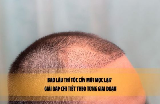 Bao lâu thì tóc cấy mới mọc lại? – Giải đáp chi tiết theo từng giai đoạn