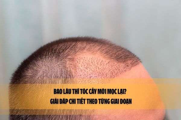 Bao lâu thì tóc cấy mới mọc lại? – Giải đáp chi tiết theo từng giai đoạn