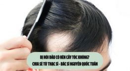 Bị hói đầu có nên cấy tóc không? Chia sẻ từ Thạc sĩ – Bác sĩ Nguyễn Quốc Tuấn