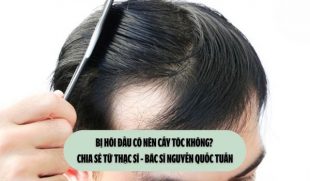 Bị hói đầu có nên cấy tóc không? Chia sẻ từ Thạc sĩ – Bác sĩ Nguyễn Quốc Tuấn