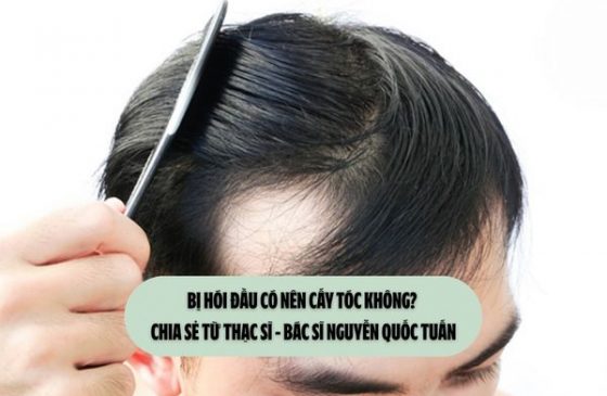 Bị hói đầu có nên cấy tóc không? Chia sẻ từ Thạc sĩ - Bác sĩ Nguyễn Quốc Tuấn