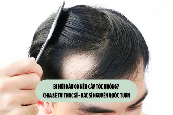 Bị hói đầu có nên cấy tóc không? Chia sẻ từ Thạc sĩ - Bác sĩ Nguyễn Quốc Tuấn