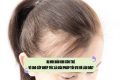 Bị hói đầu khi còn trẻ – Vì sao cấy ghép tóc là giải pháp tối ưu và lâu dài?