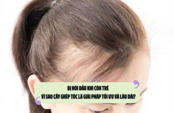 Bị hói đầu khi còn trẻ – Vì sao cấy ghép tóc là giải pháp tối ưu và lâu dài?