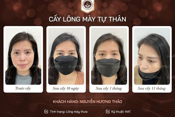 Cấy lông mày cho người không có lông mày bẩm sinh: Bí quyết giúp chân mày mọc dày, mềm và tự nhiên