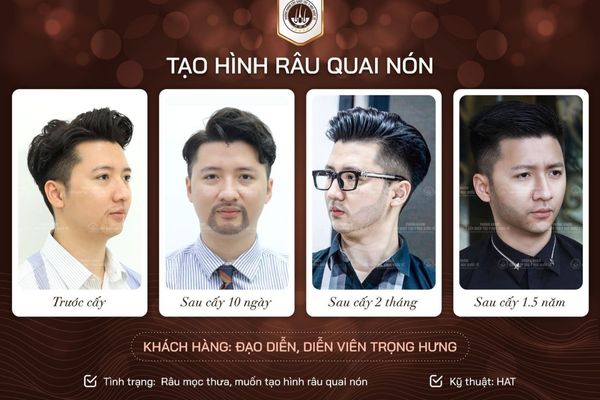 Đàn ông có nên để râu không? Góc nhìn thẩm mỹ, sức khỏe và phong cách