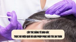 Cấy tóc bằng tế bào gốc: Thực hư hiệu quả và giải pháp phục hồi tóc an toàn