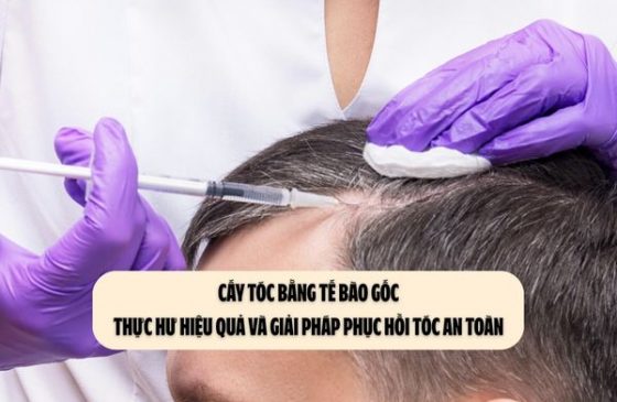 Cấy tóc bằng tế bào gốc: Thực hư hiệu quả và giải pháp phục hồi tóc an toàn