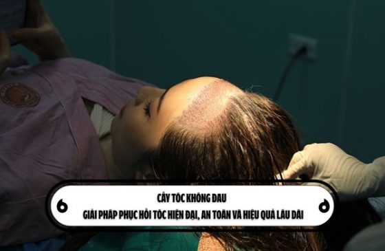 Cấy tóc không đau – Giải pháp phục hồi tóc hiện đại, an toàn và hiệu quả lâu dài