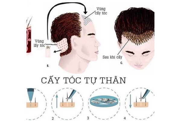 Bao lâu thì tóc cấy mới mọc lại? – Giải đáp chi tiết theo từng giai đoạn
