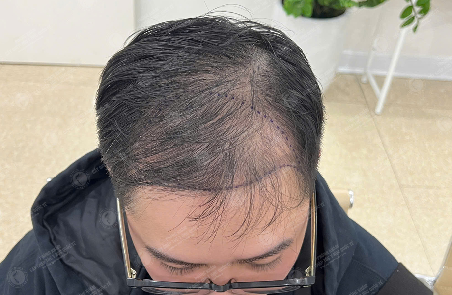 Bùi Văn Nguyên - Cấy tóc đường chữ M 2