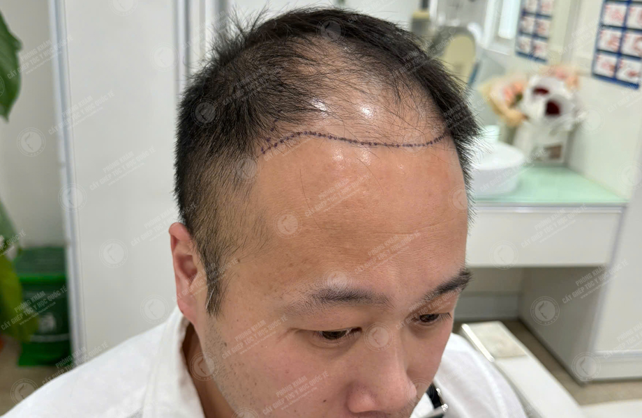 Nguyễn Hữu Cường - Cấy tóc đường chữ M 2