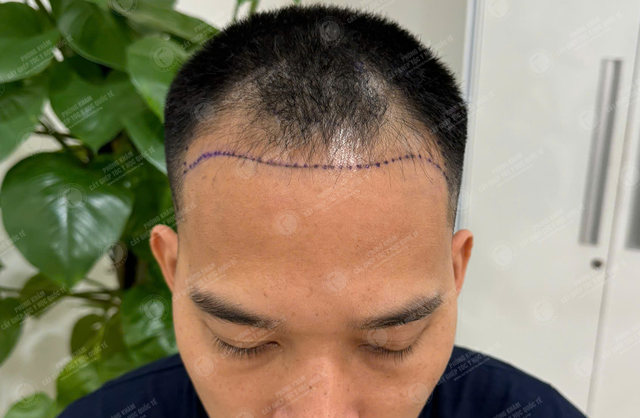 Lê Thanh Sơn - Cấy tóc đường chữ M 2