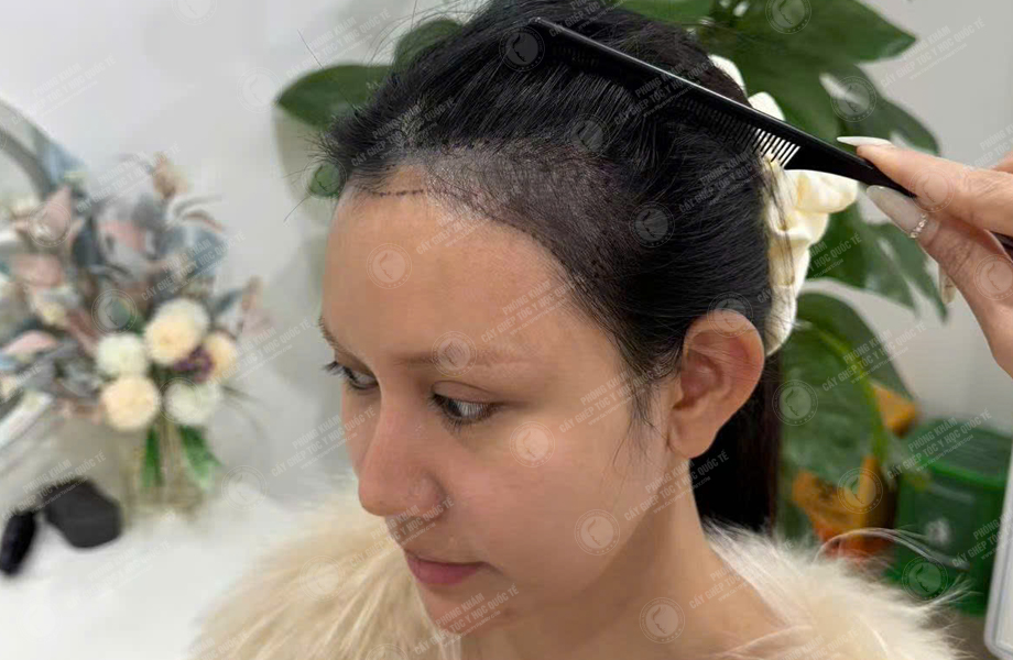 Trần Thị Huyền - Cấy tóc đường chữ M 2