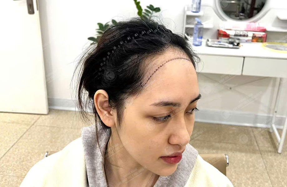 Trần Thị Hồng - Cấy tóc đường chữ M 2