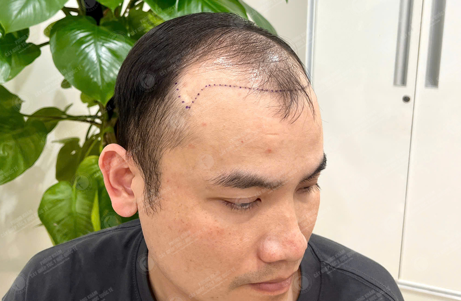 Hoàng Sơn Trung - Cấy tóc đường chữ M 2