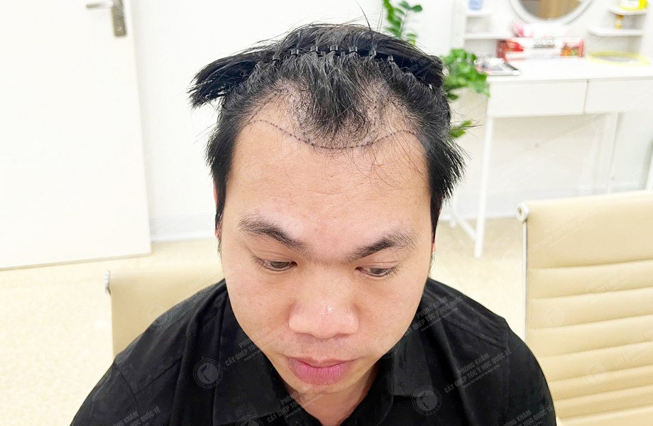 Trần Quốc Sơn - Cấy tóc đường chữ M 2