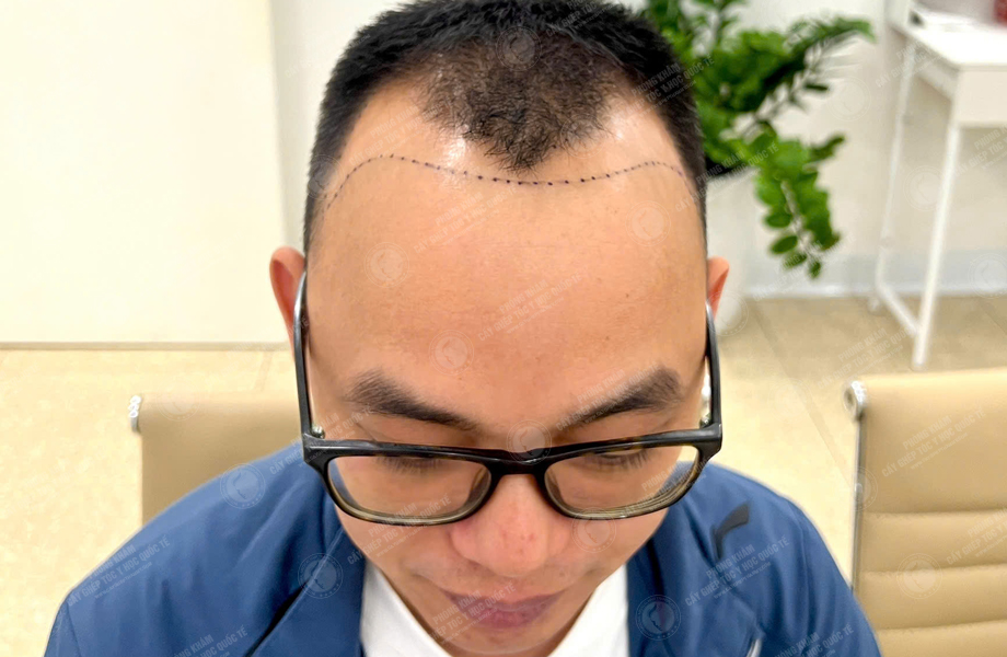 Lê Thanh Tùng - Cấy tóc đường chữ M 2