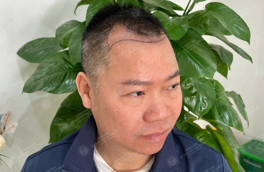 Phùng Thế Lữ - Cấy tóc đường chữ M 2