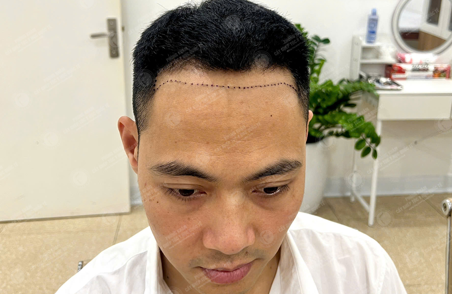 Trần Văn Nhất - Cấy tóc đường chữ M 2