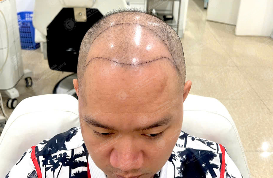 Trần Minh Linh - Cấy tóc đường chữ M 2