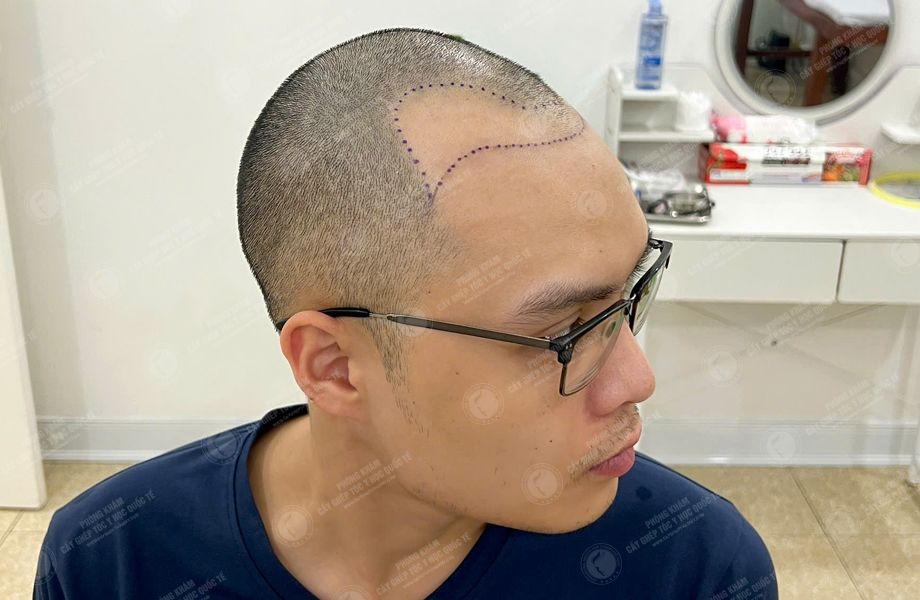 Nguyễn Thành Sơn - Cấy tóc đường chữ M 2