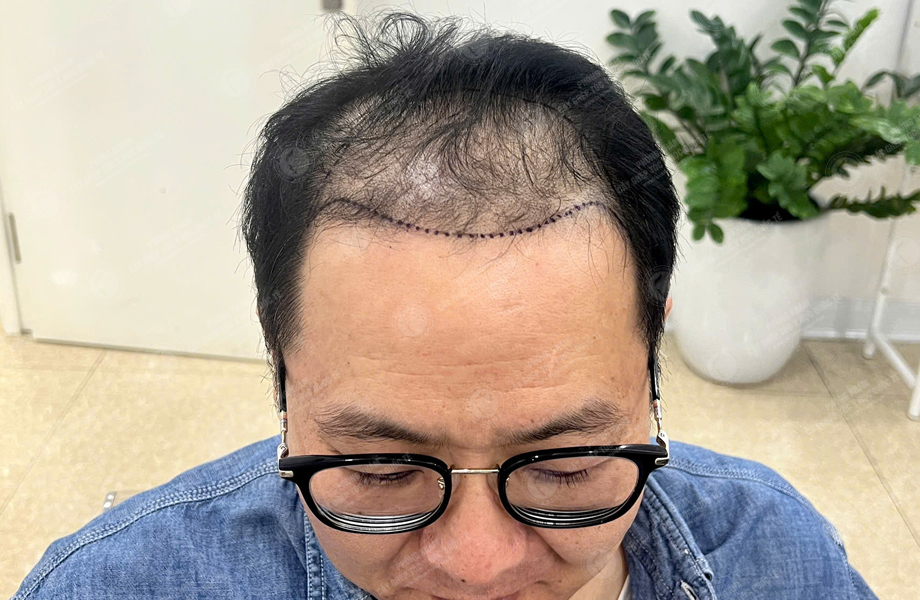 Lê Quý Sang - Cấy tóc đường chữ M 3