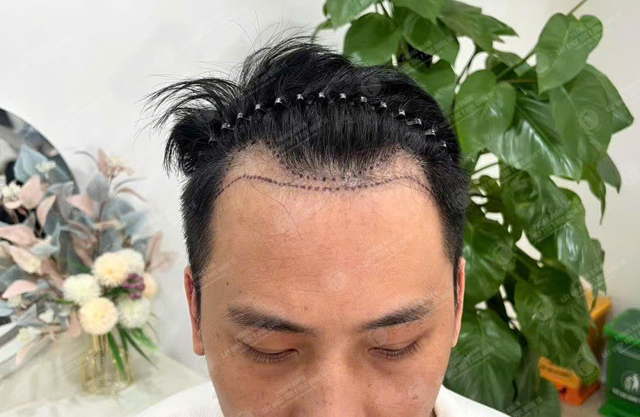 Lê Tuấn Tùng - Cấy tóc đường chữ M 2