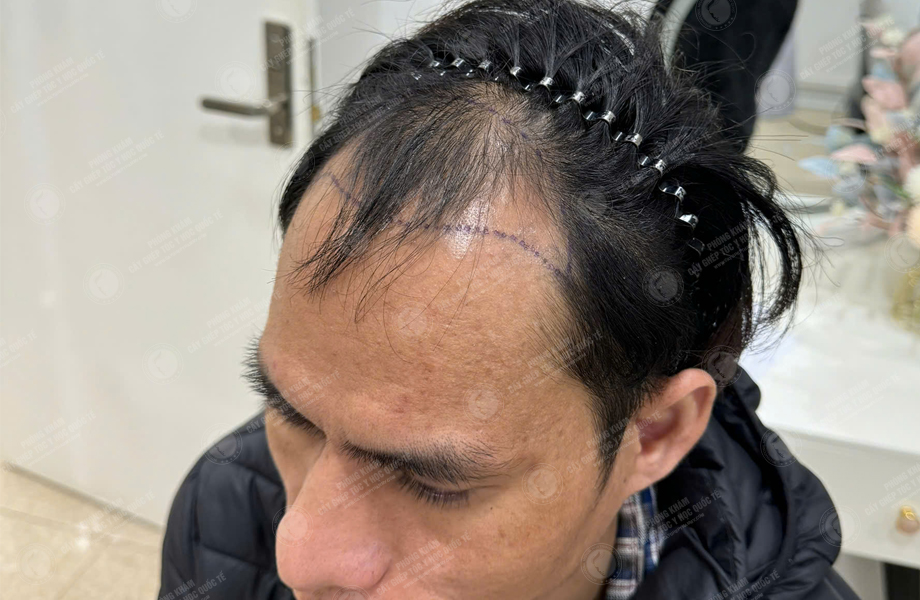 Nguyễn Đức Tâm - Cấy tóc đường chữ M 2