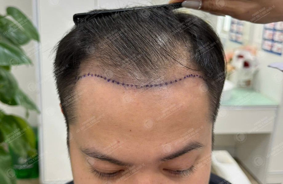 Hoàng Văn Chung - Cấy tóc đường chữ M 2