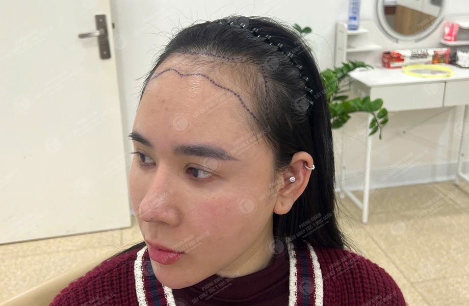 Nguyễn Tuyết Lan - Cấy tóc đường chữ M 2