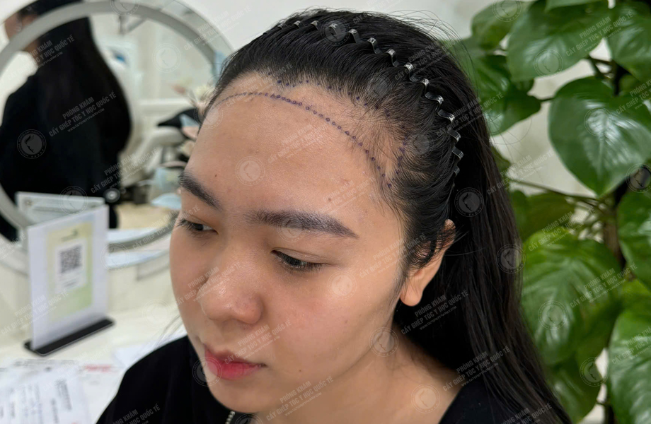 Nguyễn Hồng Hạnh - Cấy tóc đường chữ M 2