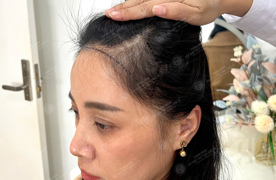 Lê Ánh Nguyệt - Cấy tóc đường chữ M 2