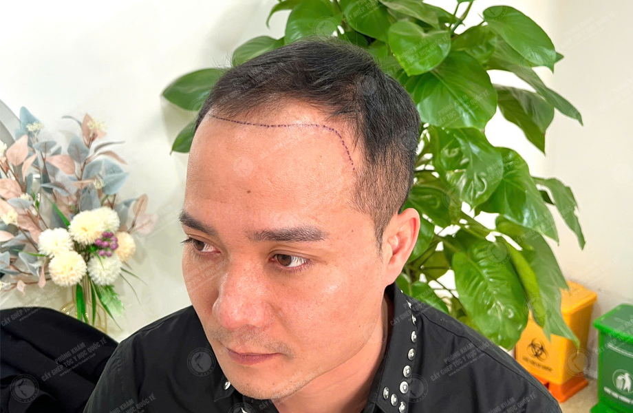 Trần Quốc Hoàn - Cấy tóc đường chữ M 2