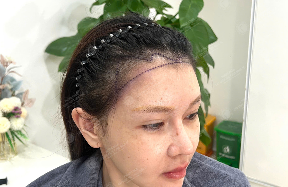 Nguyễn Mai Hoa - Cấy tóc đường chữ M 2