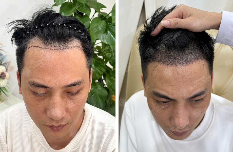  Lê Tuấn Tùng - Cấy tóc đường chữ M 1