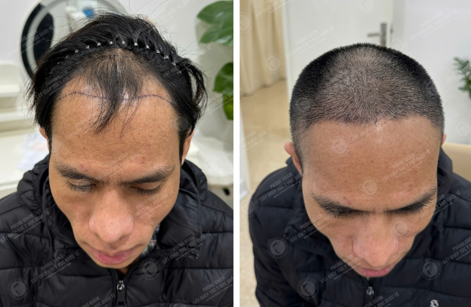  Nguyễn Đức Tâm - Điều chỉnh đường chân tóc 1