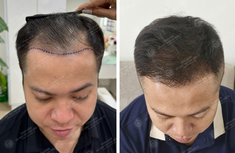  Hoàng Văn Chung - Cấy tóc tự thân 1